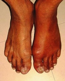Second Pair of Swollen Gouty Feet