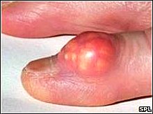 Gout+in+My+Finger Gout in My Finger http://www.pic2fly.com/Gout+in+My ...