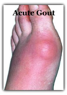 Acute Gout | The Gout Killer - Bert Middleton