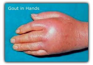 Very Swollen Gouty Left Hand