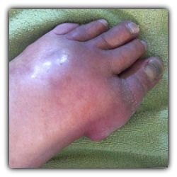 Cause of Death: Gout. Can Gout Kill You? Yes - Keep Reading.