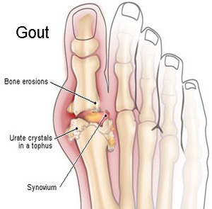 Gout Uric Acid in Big Toe Joint