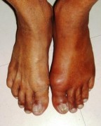 Pair of Feet with Gout