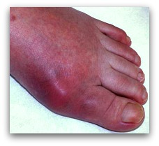Podagra IS Gout In Big Toe . . . or The WHOLE Foot