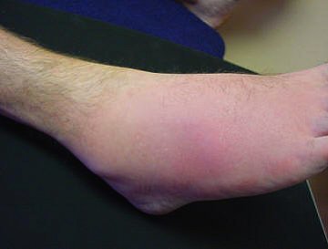Extremely Red, Swollen Gouty Ankle