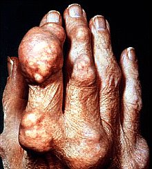 Fingers with Large Lumps of Tophi