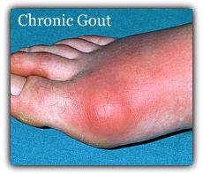 Red, Inflamed, Gouty Big Toe