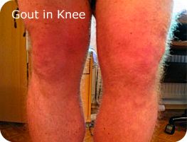 Left Knee Swollen with Gout