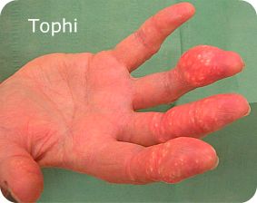 Right Hand with Massive Tophi