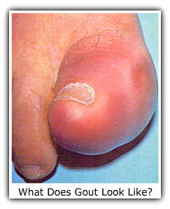 Extremely Red Gouty Big Toe
