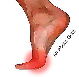 Drawing of Foot with Inflammed, Red Big Toe Joint