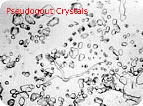 Microscopic View of Pseudogout Crystals