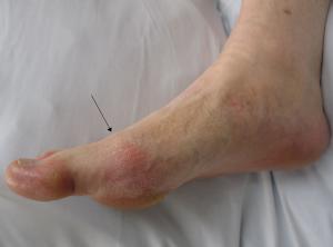 Complications of Gout