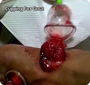 cupping-for-gout
